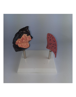 ERKENTMED A11 SİGARA İÇEN AKCİĞER MODELİ